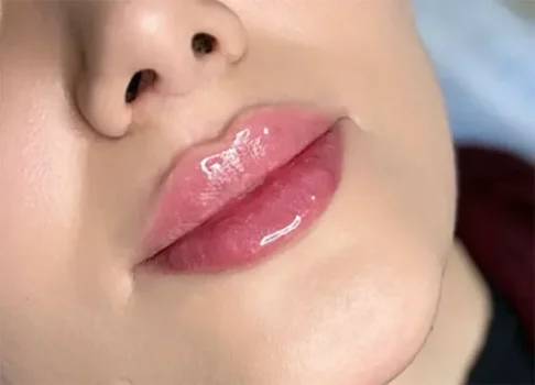 پروسه تزریق فیلر لب ایده آل